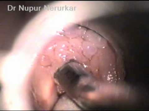 Cancer in gura tratament