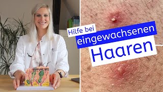 Hilfe bei eingewachsenen Haaren | Ursachen | schnelle Hilfe | Vorbeugung | Therapie