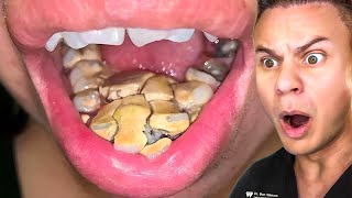 Orthodontist Reacts To Disgusting Teeth Cleanings