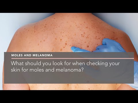 What should you look for when checking your skin for moles and melanoma?