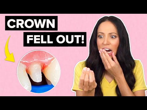 What to Do If Your Dental Crown Fell Out