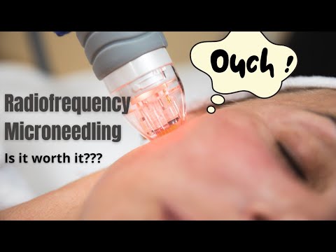 Radiofrequency Microneedling | Does it actually work? | Dermatologist reviews