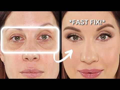 Dark Circles & Hollow Under Eyes? Try These Fast Fixes!