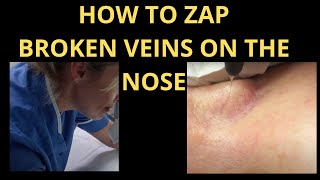 How To Get Rid of Spider Veins on the Cheeks, Chin and Nose