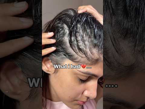 I was Going Bald 😭 but this saved my hair ✨ #hairthinning #hairfall #hairgrowthserum #haircare