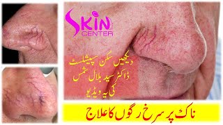 Spider veins on nose treatment by skin specialist dr syed bilal shams @skincenter.pakistan