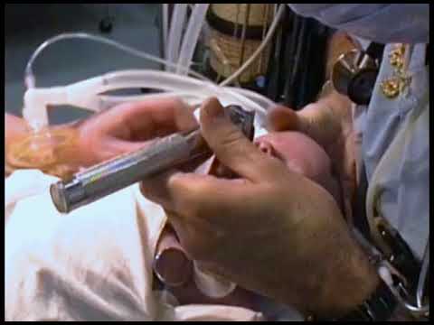 7-37.  Intubation of an Infant