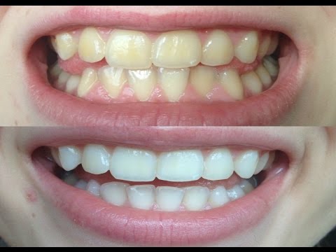 How I whitened my VERY yellow teeth! (WORKS!) BEFORE AND AFTER!