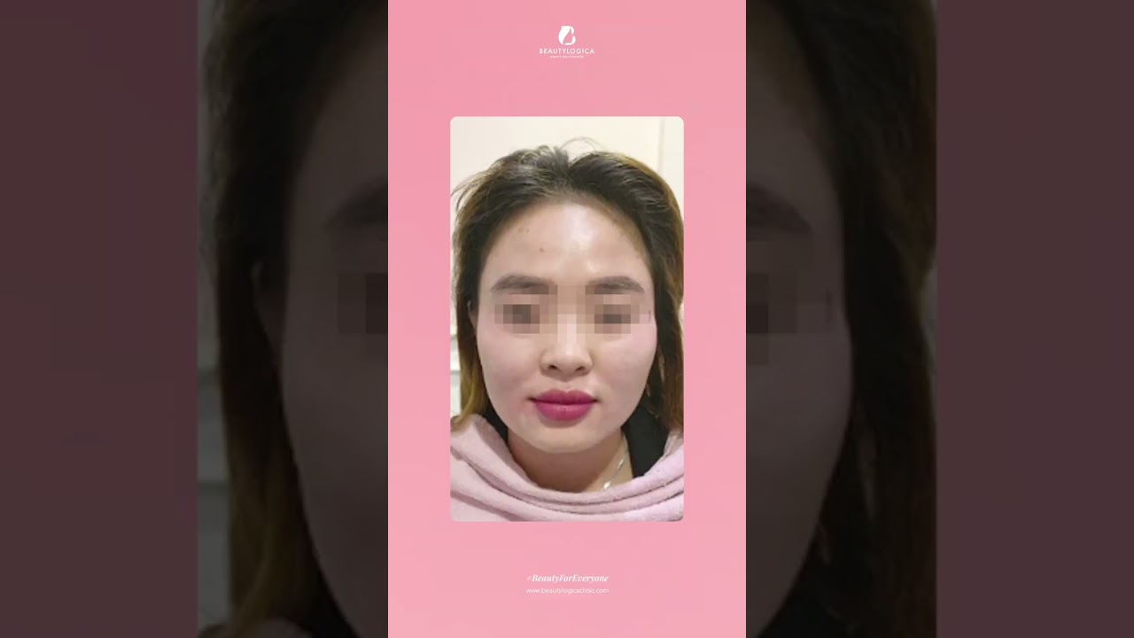 Thread Lift Beautylogica Bintaro