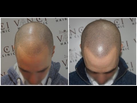 Akriderm bei der Schuppenflechte der Preis Die Schuppenflechte von den Nerven die Behandlung