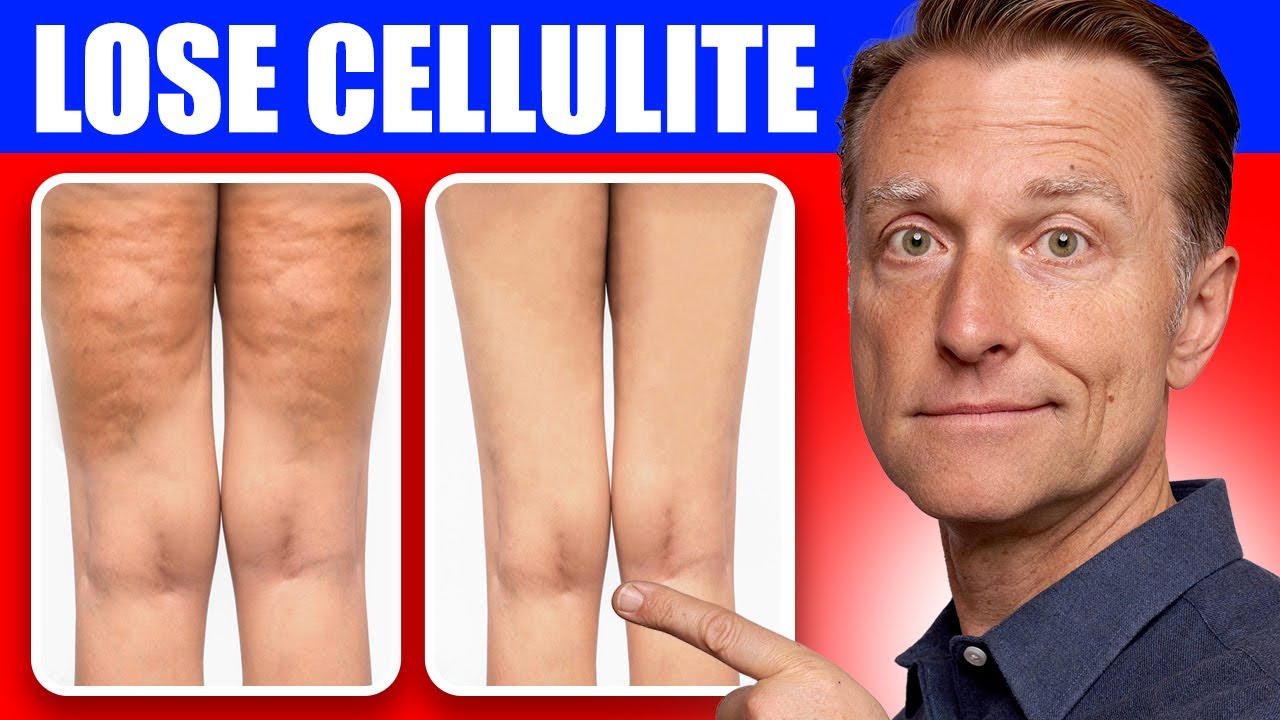 How to Get Rid of Cellulite: A Step-by-Step Guide, Beauty Vigour
