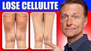 Get Rid of Cellulite for Good: Dr. Berg