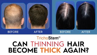 How Thinning Hair can Become Thicker Hair