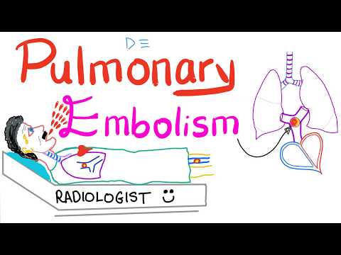 Pulmonary Embolism (PE) - Causes, Symptoms, Signs, Diagnosis & Treatment - Respiratory System