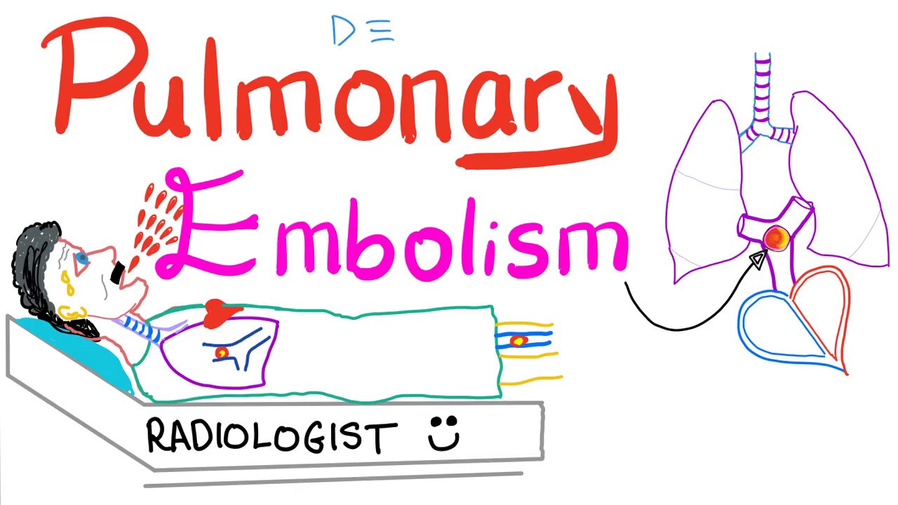 Pulmonary Embolism (PE) - Causes, Symptoms, Signs, Diagnosis & Treatment - Respiratory System