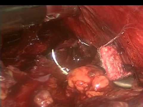  Improving Pneumoperitoneum With Relaxing Incisions During Laparoscopic Fundoplication