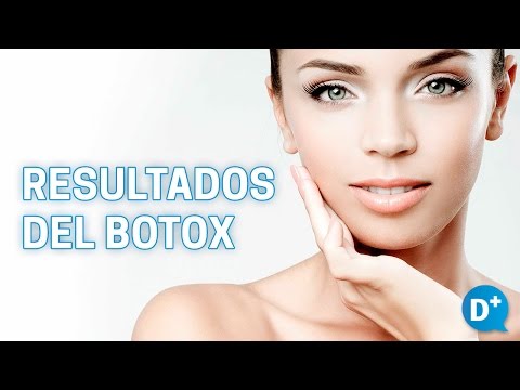 Resultados del tratamiento de bótox