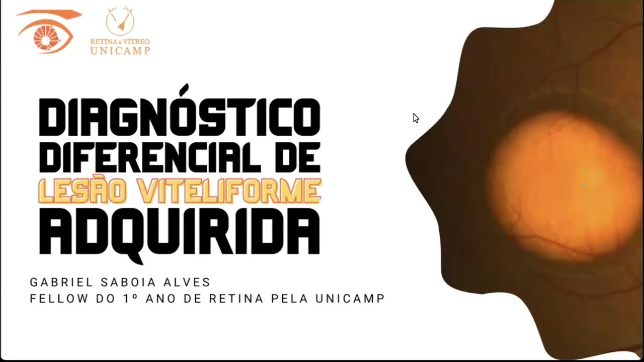 Retina e Vítreo (27/06/2024) - Diagnóstico Diferencial de Lesão Viteliforme Adquirida