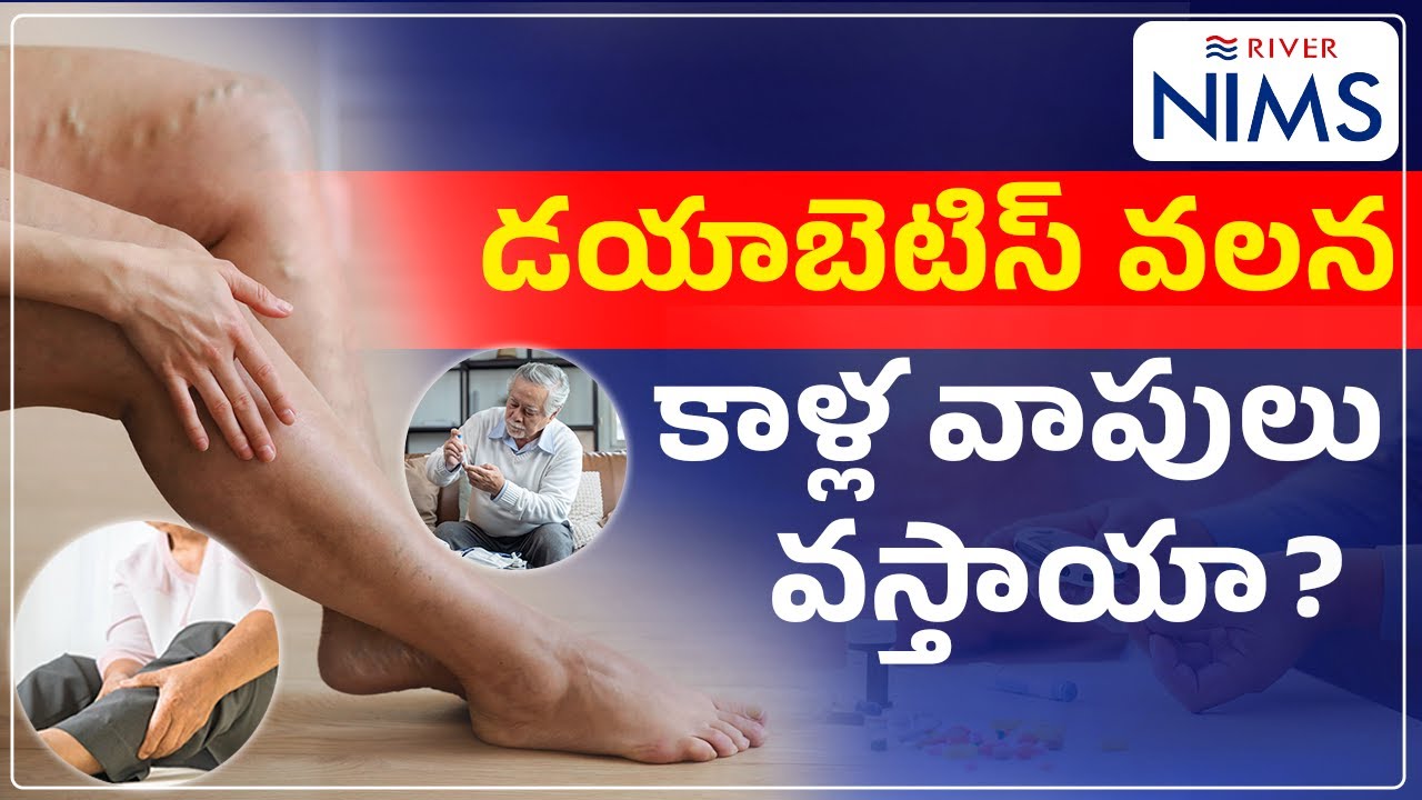 | Does Diabetes Cause Swollen Legs? | Causes, Symptoms & Management |River Nims Hospitals Nalgonda|