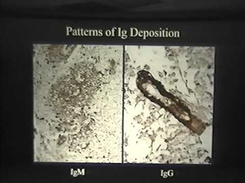 Immunopathology of Neuromyelitis Optica/Devic's Disease