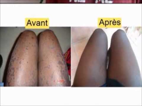 comment soigner eczema pied