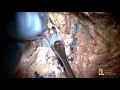 Far Lateral Craniotomy for PICA and Vertebral Basilar Junction - Aaron Dumont, MD, FACS, FAHA