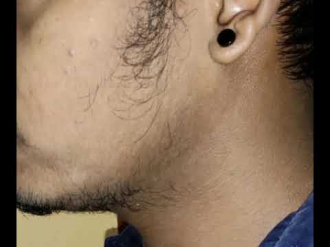 Minoxidil beard growth.. 3 months journey 👍