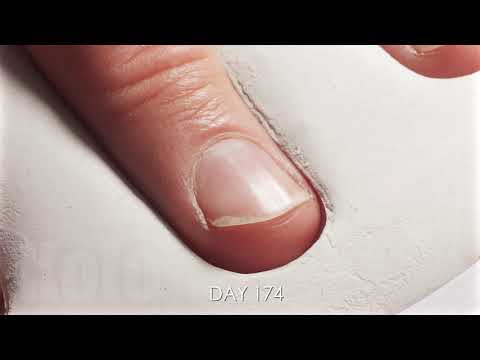 One Year Time Lapse of Growing-Trimming Fingernail