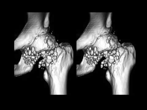 ízületi chondromatosis kezelés)