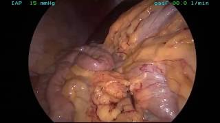Malrotation - laparoscopic Ladd's procedure Malrotation - laparoscopic Ladd's procedure