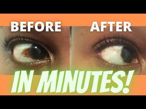 How to get rid of brown spot on eye Discolouration|...