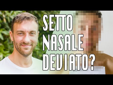 Rinosettoplastica con Pietro Palma | Setto nasale deviato | L'esperienza di Ale demaria