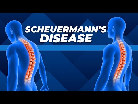 Reizung des Halses der Männer behandelt Fixierung des Hüftgelenks bei einem Kind