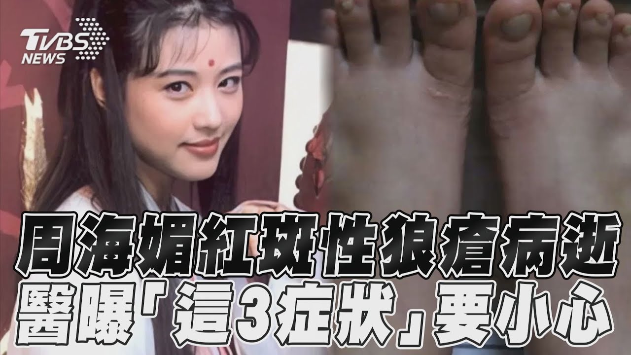 影音/周海媚罹「紅斑性狼瘡」病逝! 醫曝女性「3症狀要小心」