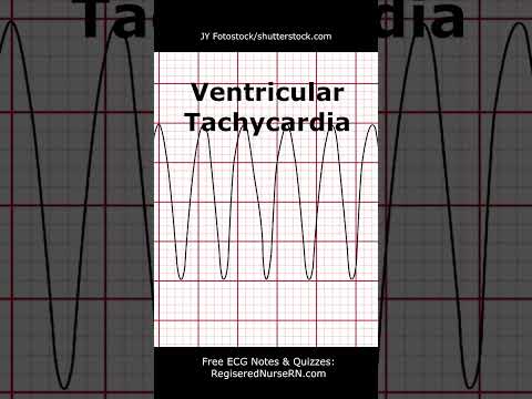 ECG (EKG) Heart Rhythms POP Quiz: Can You Identify These Heart Rhythms? #shorts #ecg #nursing