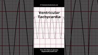 ECG (EKG) Heart Rhythms POP Quiz: Can You Identify These Heart Rhythms? #shorts #ecg #nursing