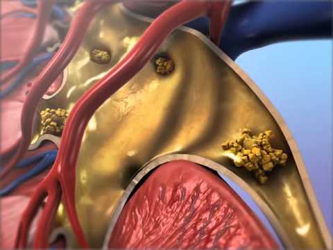 Kidney Stones: Learn@Visible Body