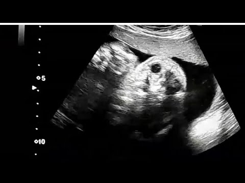 Conjoined twins with thoracopagus and omphalopagus variety|#ultrasound #medicine #doctor #mbbs #obs