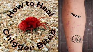 How to heal CHIGGER BITES fast! | Chigger Bite Jigger Bugs Bite