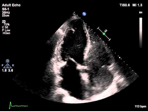 Affiniti S5 1 Contrast LVO WMAs