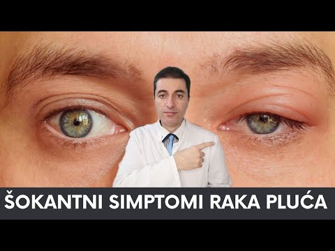 ŠOKANTNI i jako ČUDNI SIMPTOMI RAKA PLUĆA
