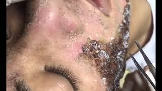Chemical Peel Result After Treatment - Face Peel for Acne Part 1 (22 August 2019)