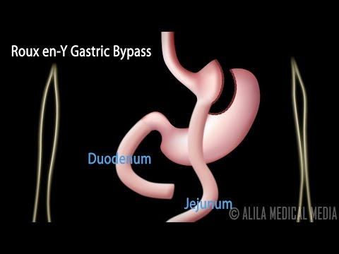 Roux en-Y Gastric Bypass, with Introduction on Body Mass Index, Animation.