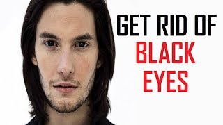Get Rid Of A Black Eye Fast Naturally At Home