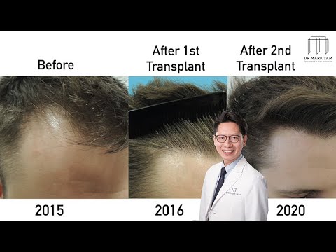 Hair Transplant Before and After | 5 Year Hairline Restoration | Dr Mark Tam