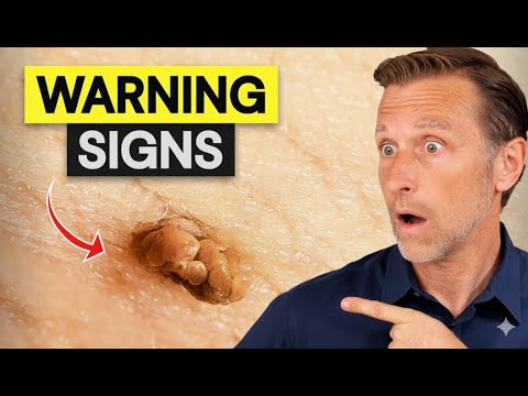 How To Remove Skin Tags And Warts Overnight