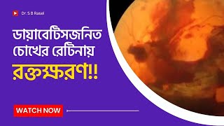 Diabetic Retinal Hemorrhage - ডায়াবেটিসজনিত চোখের রেটিনায় রক্তক্ষরণ!!