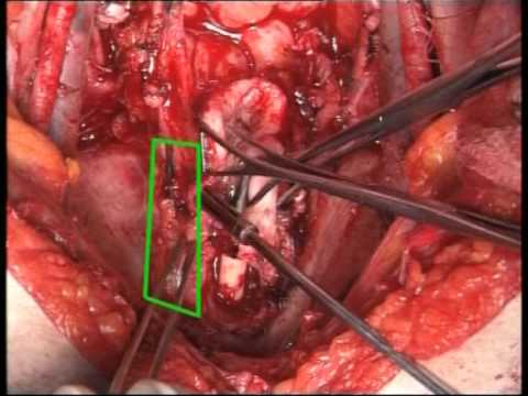 Radical Cystectomy (Nerve Sparing) With Orthotopic Bladder Replacement