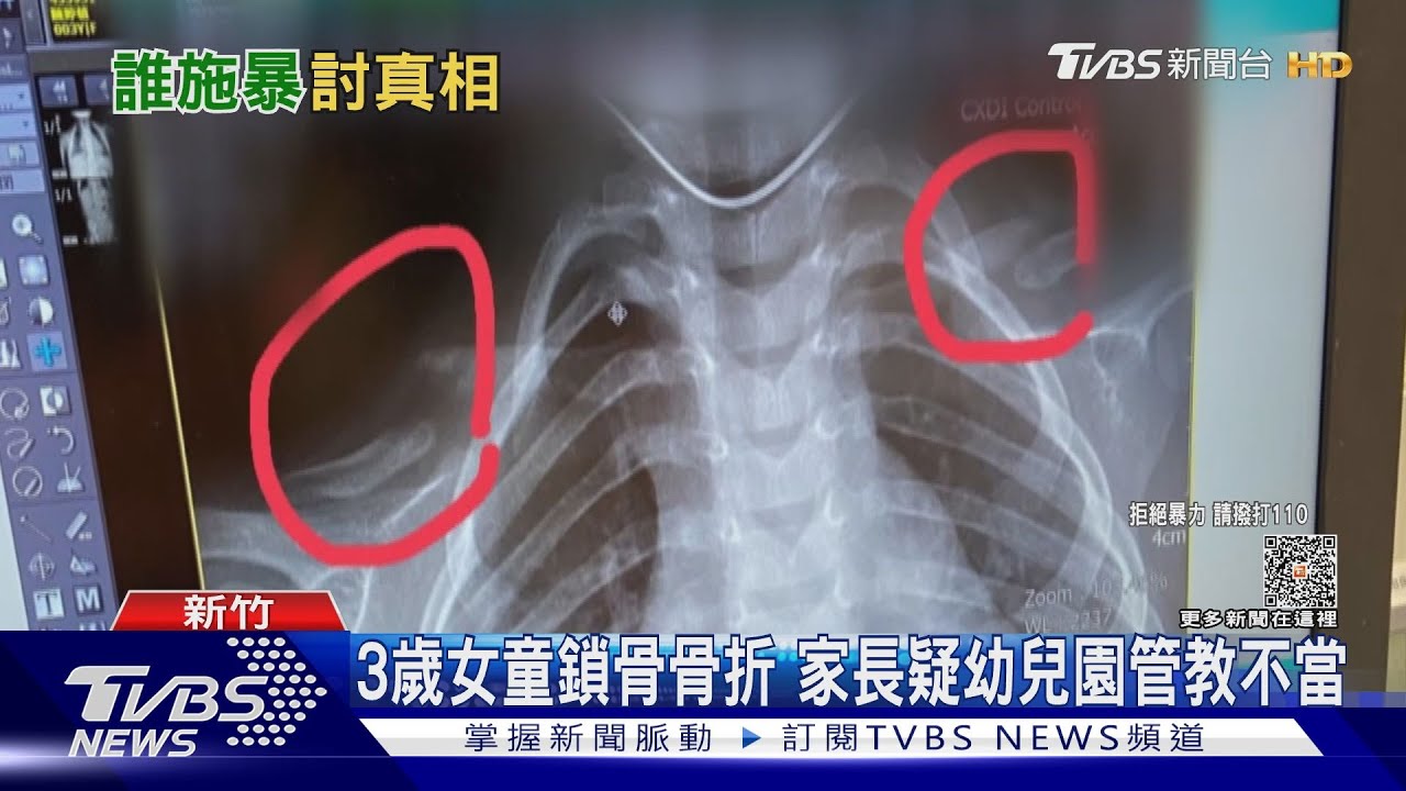 3歲女童鎖骨骨折!家長疑幼兒園管教不當