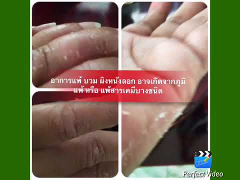 กลากเชื้อโรคติดเชื้อ กลากของยาหม่องดอกจัน